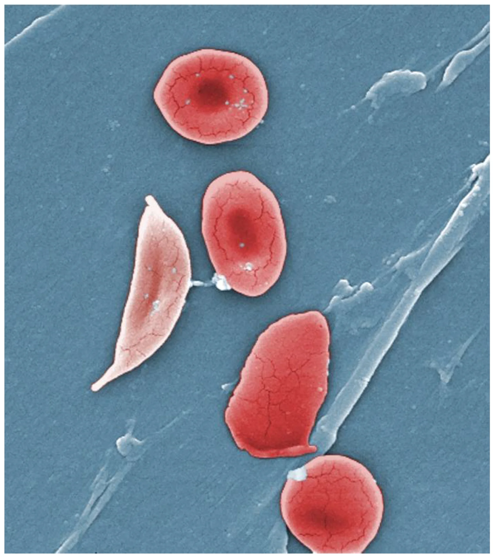 Hematopoiesis & Aplasia Sumsum Tulang
