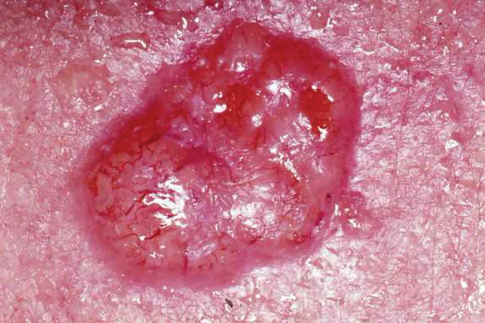 Kanker Kulit: BCC, SCC, Melanoma
