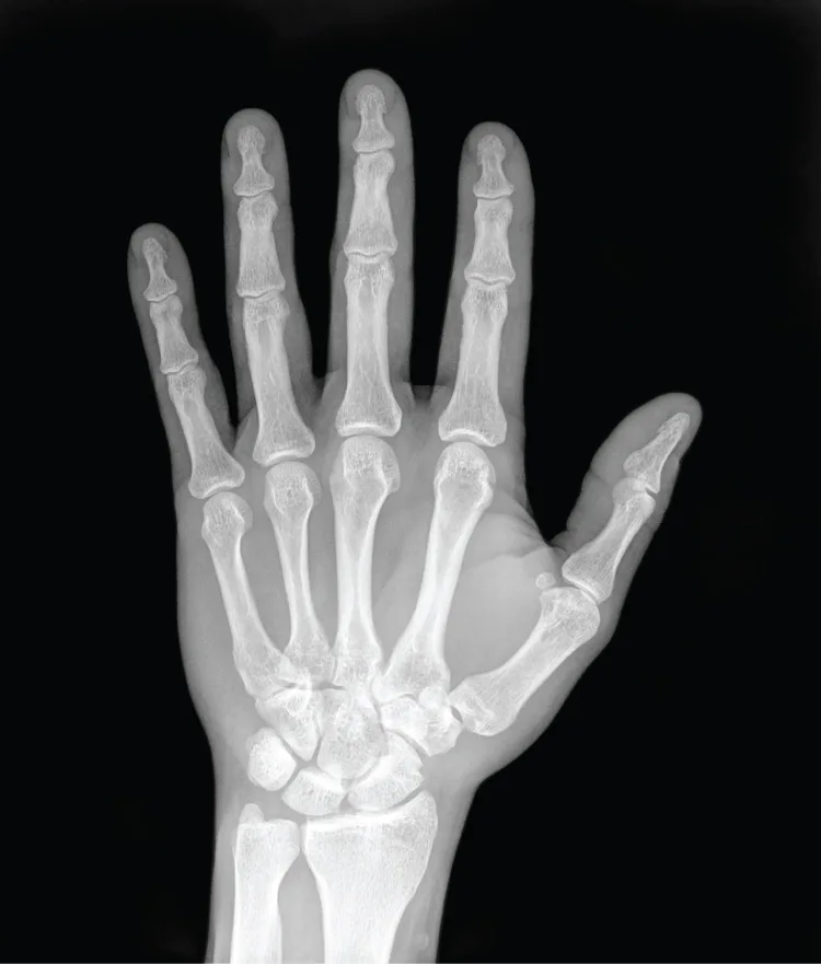 X-Ray Tangan
