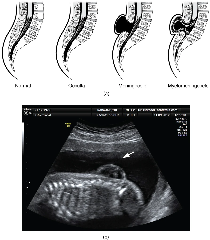 Spina Bifida & Defek Tabung Neural